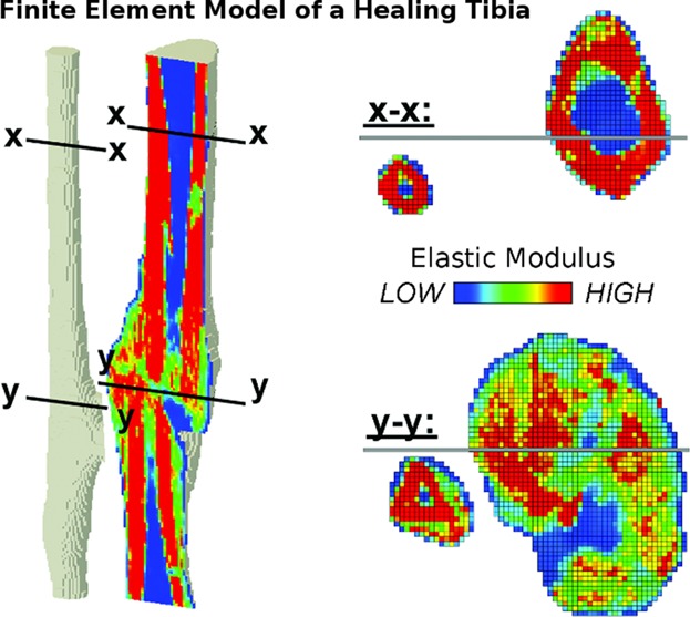 Virtual stress testing of fracture stability in soldiers with severely comminuted tibial fractures