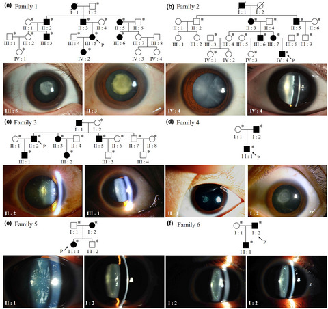 Identification and characterization of six β-crystallin gene mutations associated with congenital cataract in Chinese families