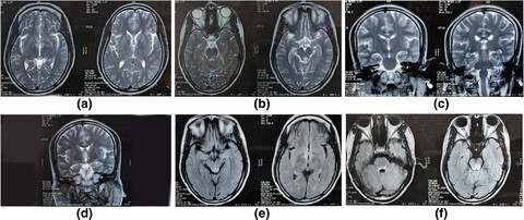 Wernicke’s encephalopathy precipitated by neuromyelitis optica spectrum disorder and Graves’ disease: A tale of clinical and radiological dilemmas