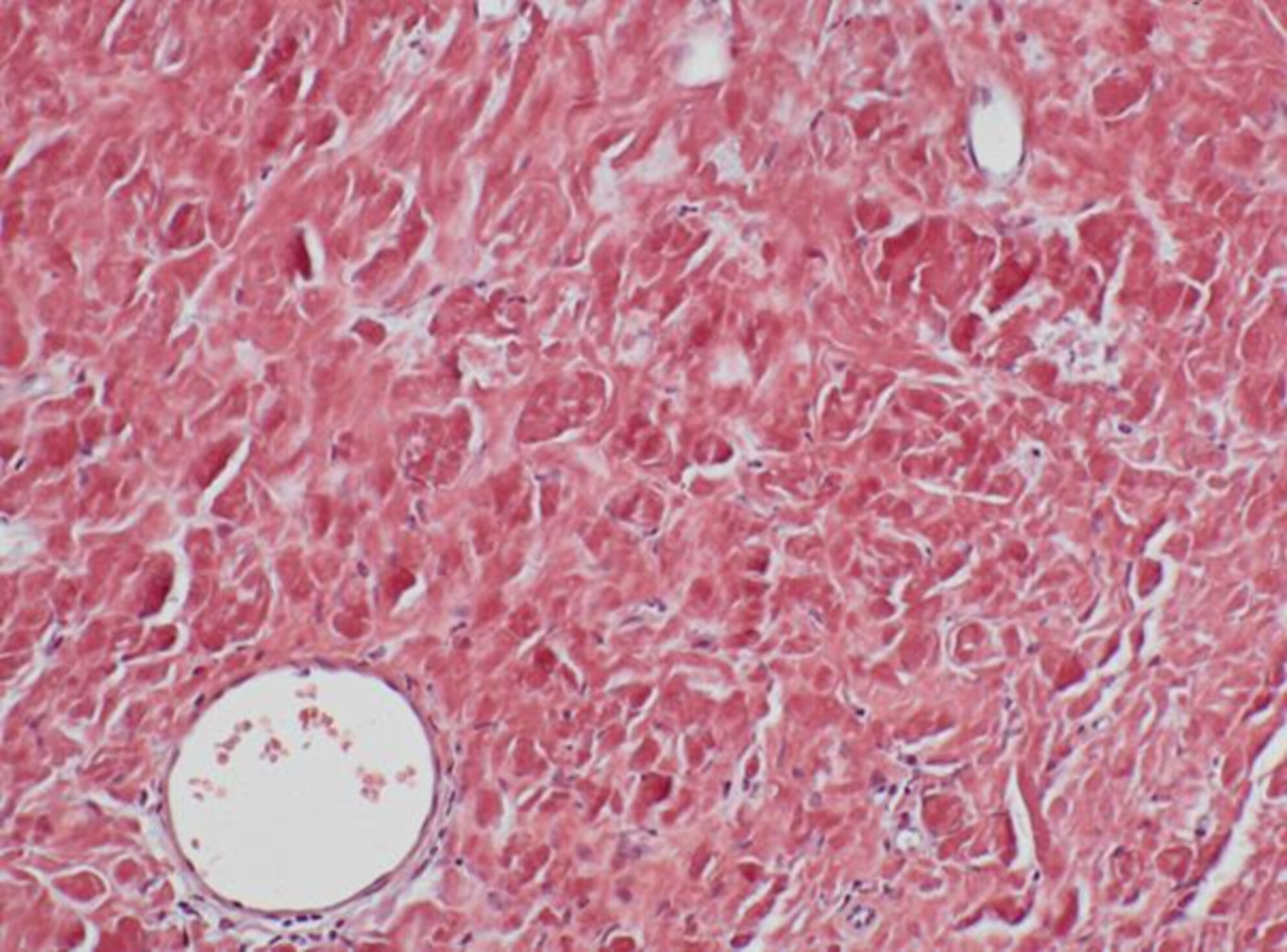 Localized Amyloidosis of the Oral Cavity: A Rare Clinical Entity