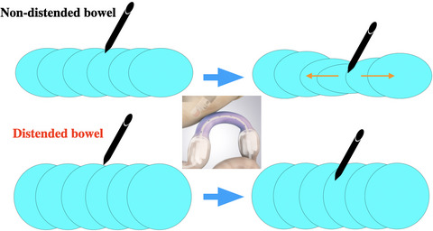 EUS-guided gastrojejunostomy: Double-balloon occlusion theory with experimental study (with video)