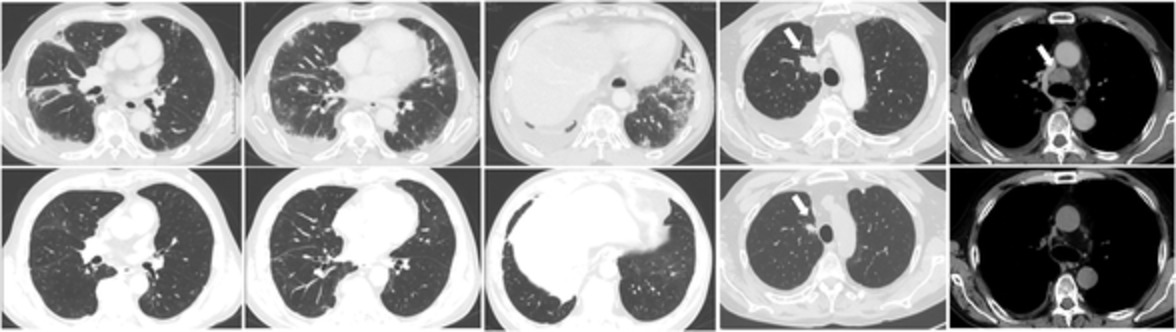 EGFR-mutant lung adenocarcinoma associated with antisynthetase syndrome successfully treated with osimertinib