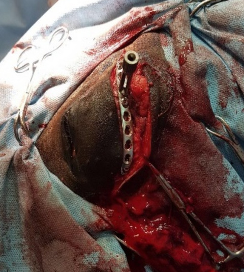 Surgical repair of a depressed, comminuted fracture of the zygomatic process of the frontal bone using a locking compression plate in a Thoroughbred colt foal