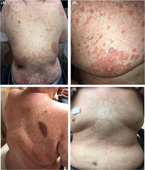 Pityriasis rubra pilaris-like graft-vs-host disease following allogeneic stem cell transplant in two patients