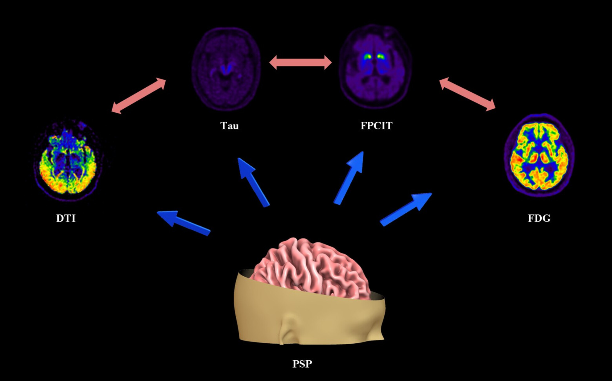 Relationships Between Glymphatic System Activity and Tau Burden, Dopaminergic Impairment, Abnormal Glucose Metabolism in Progressive Supranuclear Palsy