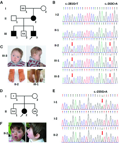 Disruption of TWIST1 translation by 5′ UTR variants in Saethre-Chotzen syndrome
