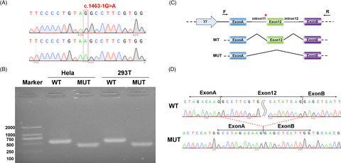 Christianson syndrome: A novel splicing variant of SLC9A6 causes exon skipping in a Chinese boy and a literature review