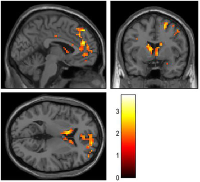 Task-induced deactivation dysfunction during reward processing is associated with low self-esteem in a possible subtype of major depression