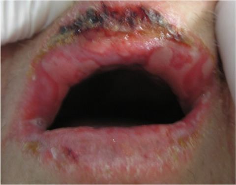 Erosive cheilitis as an early manifestation in DRESS syndrome