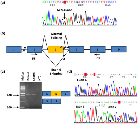 Identification of novel splice mutation in SMAD3 in two Cypriot families with nonsyndromic thoracic aortic aneurysm. Two case reports