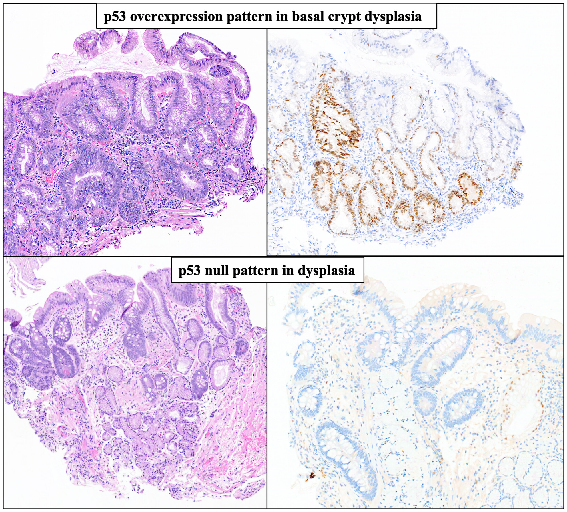 The future is now: advancing p53 immunohistochemistry in Barrett's oesophagus and its implication for the everyday pathologist