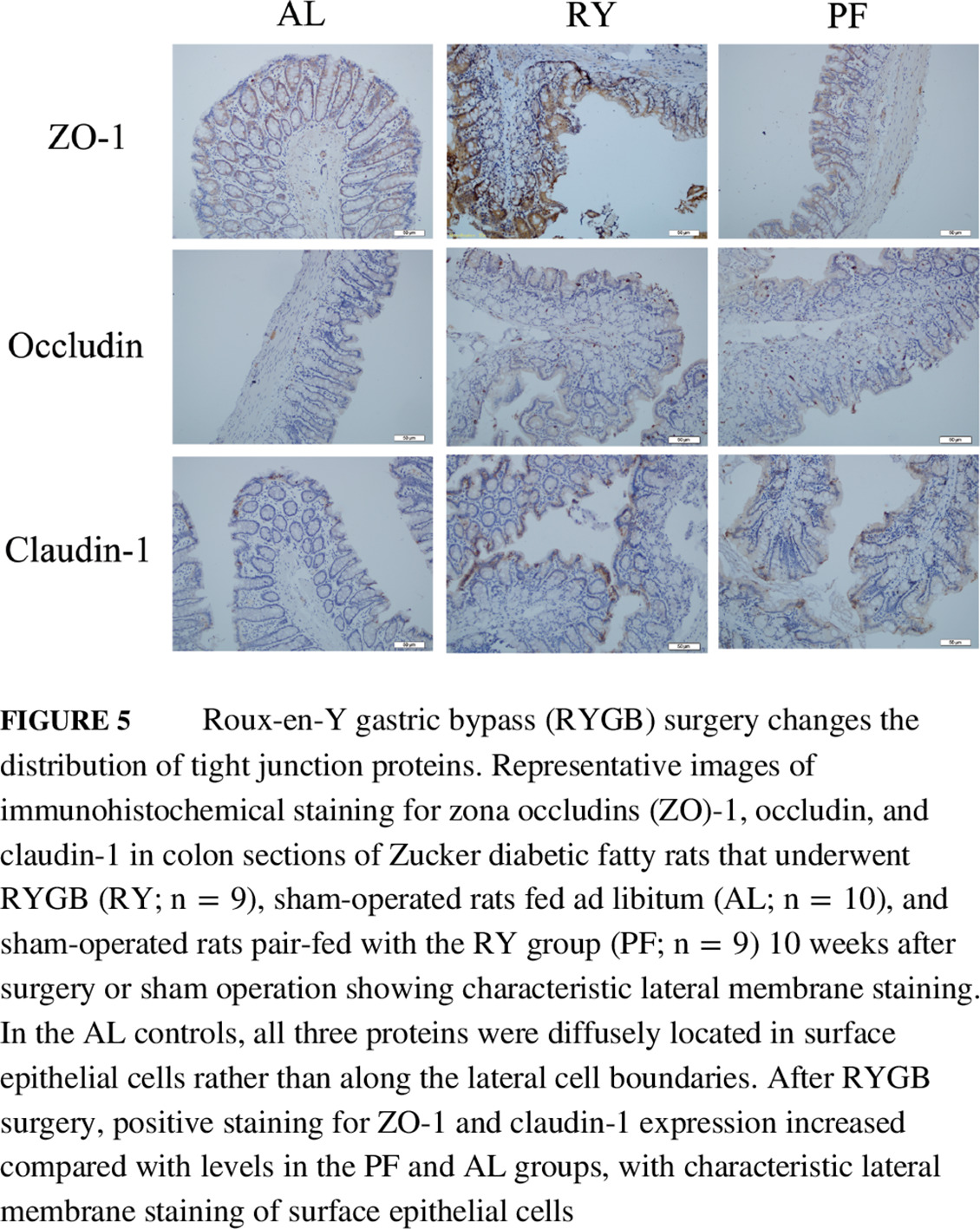 Roux-en-Y gastric bypass decreases endotoxemia and inflammatory stress in association with improvements in gut permeability in obese diabetic rats RYGB手术减少内毒素血症和炎症应激反应同时改善肥胖糖尿病大鼠肠道通透性