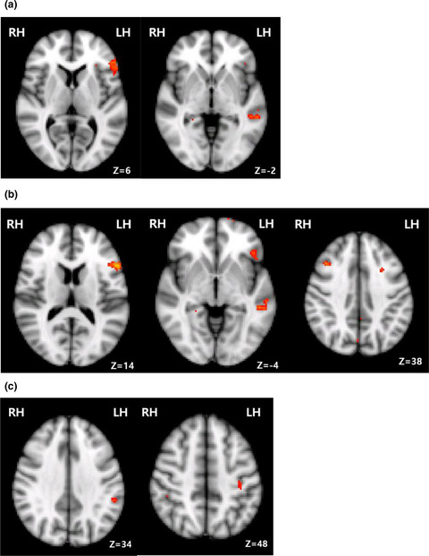 Perilesional and homotopic area activation during proverb comprehension after stroke