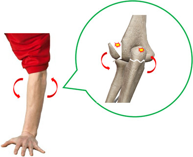Possible Mechanism and Treatment Results of Combined Pediatric Fractures of the Humeral Lateral Condyle and Ipsilateral Ulnar Olecranon