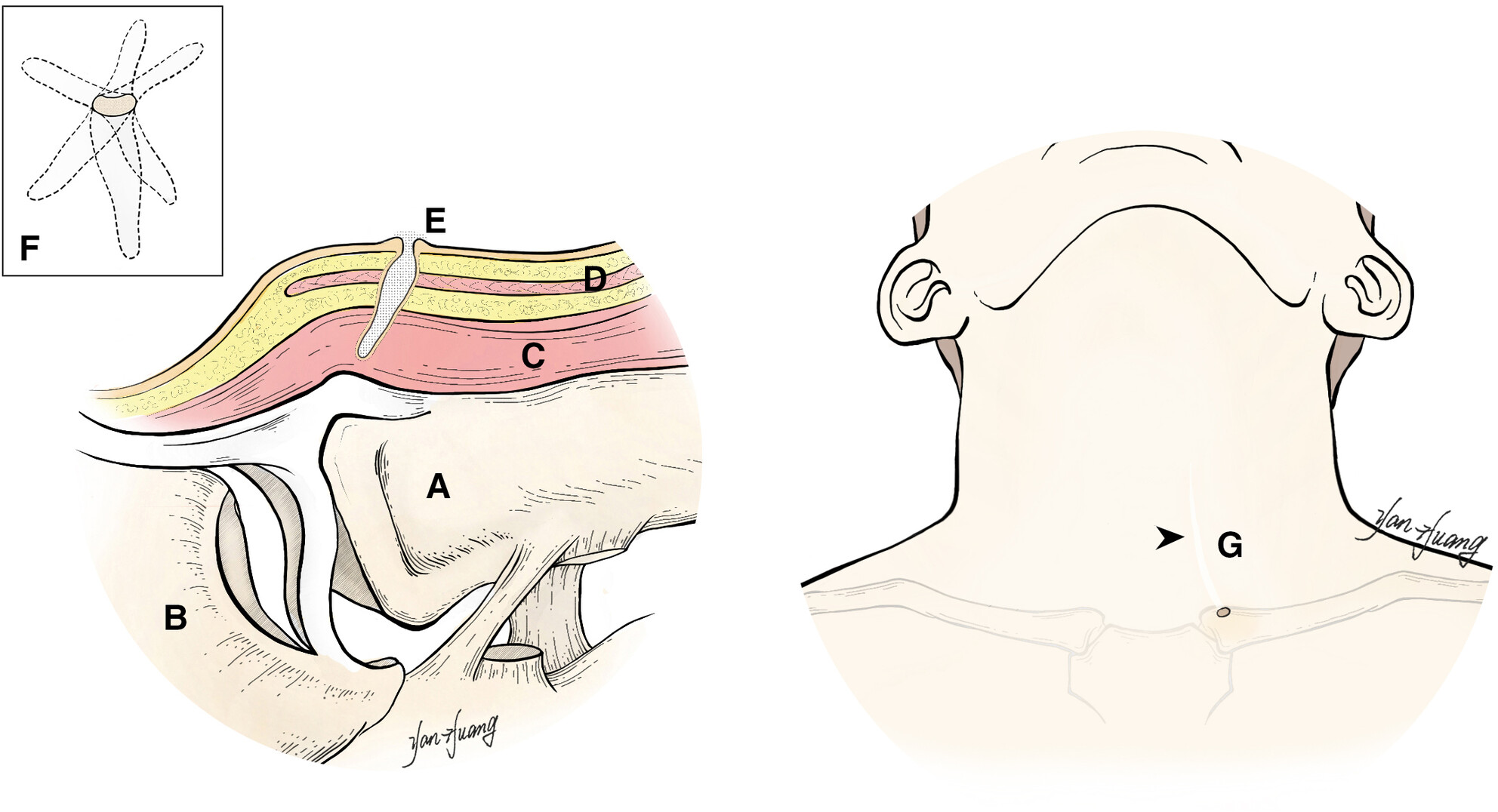 Congenital Sternoclavicular Sinus—Case Series of a Rare Lower Neck Deformity