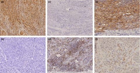 Programmed death-ligand 1 expression at tumor invasive front is associated with epithelial-mesenchymal transition and poor prognosis in esophageal squamous cell carcinoma