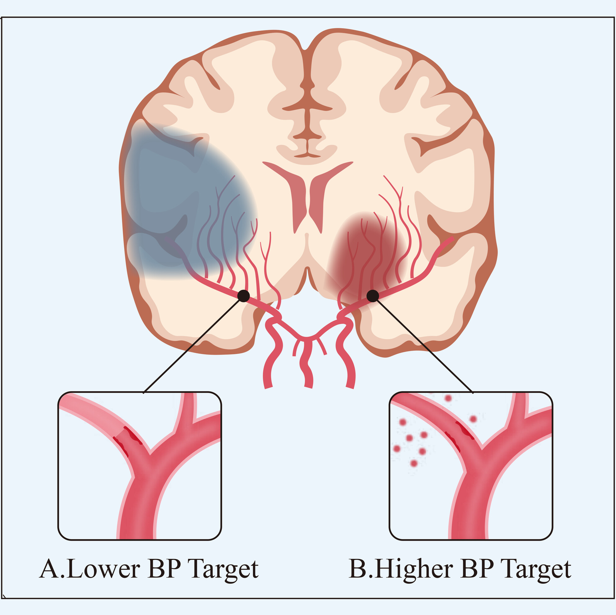 Blood pressure management after endovascular thrombectomy: Insights of recent randomized controlled trials