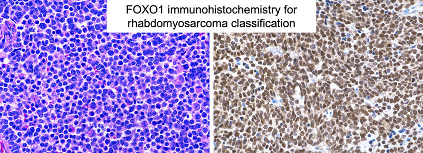Diagnostic utility of FOXO1 immunohistochemistry for rhabdomyosarcoma classification