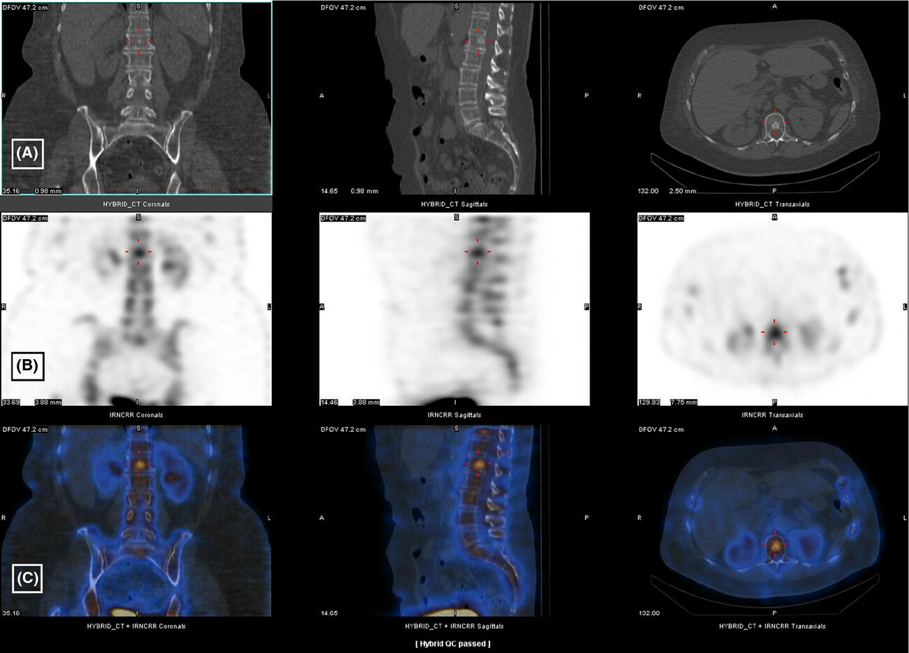 The role of general nuclear medicine in breast cancer
