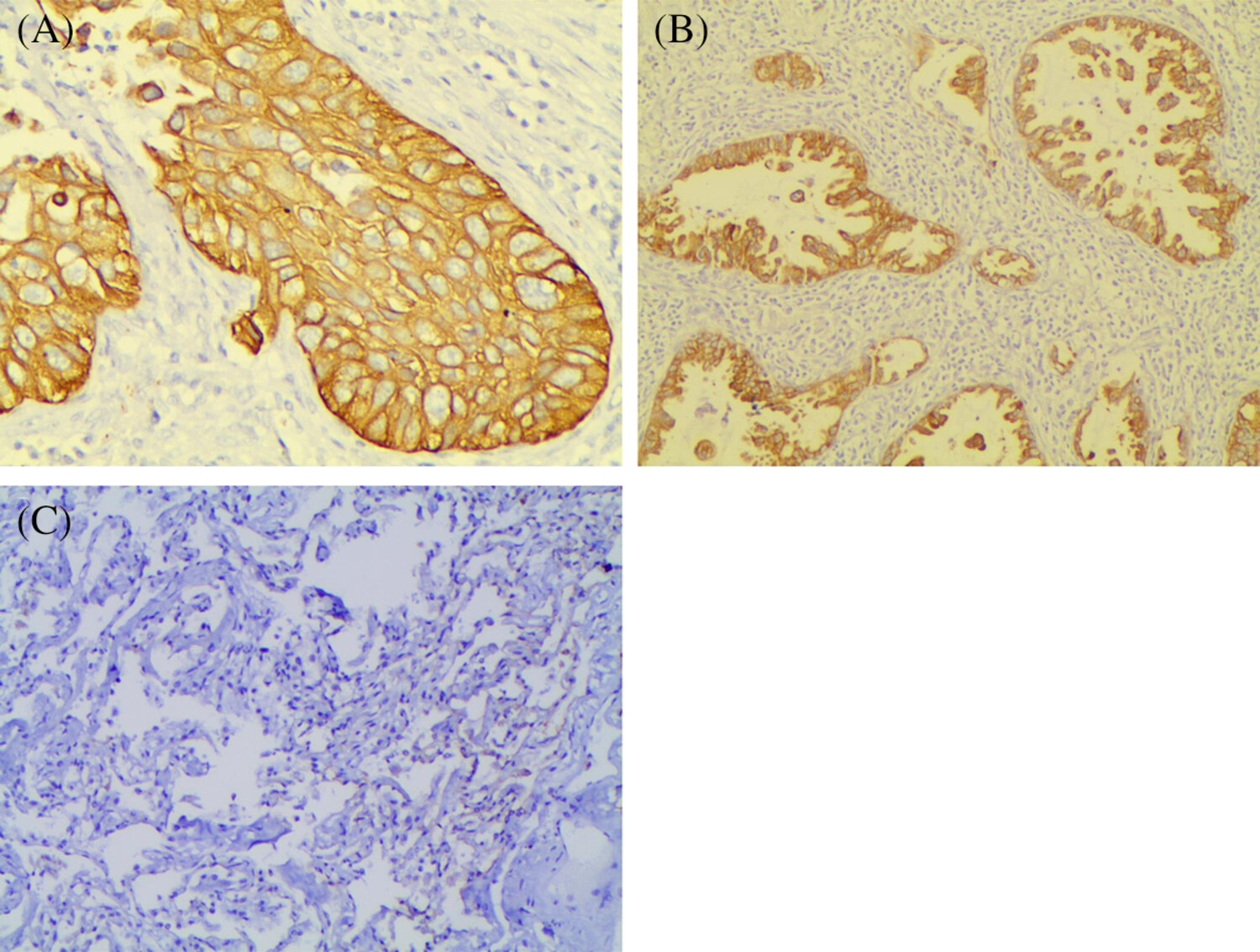 Expression and prognostic value of Cripto-1 in early non-small cell lung cancer