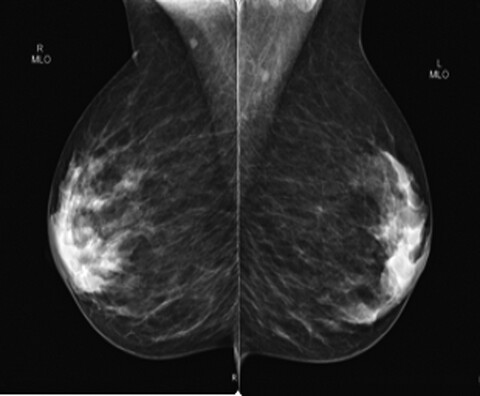 Mammographic parenchymal patterns and breast cancer risk in New South Wales North Coast Aboriginal and Torres Strait Islander women