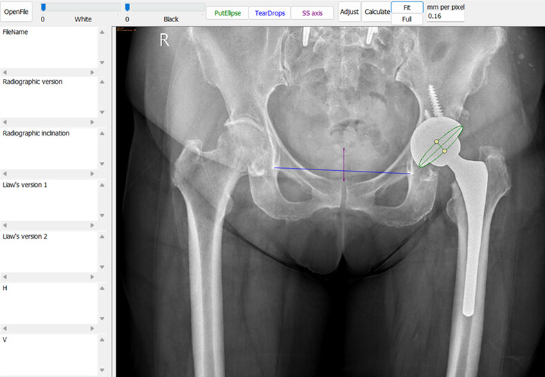 Liaw's Ellipse Anteversion Method for Distinguishing Acetabular Component Retroversion from Anteversion on Plain Radiographs