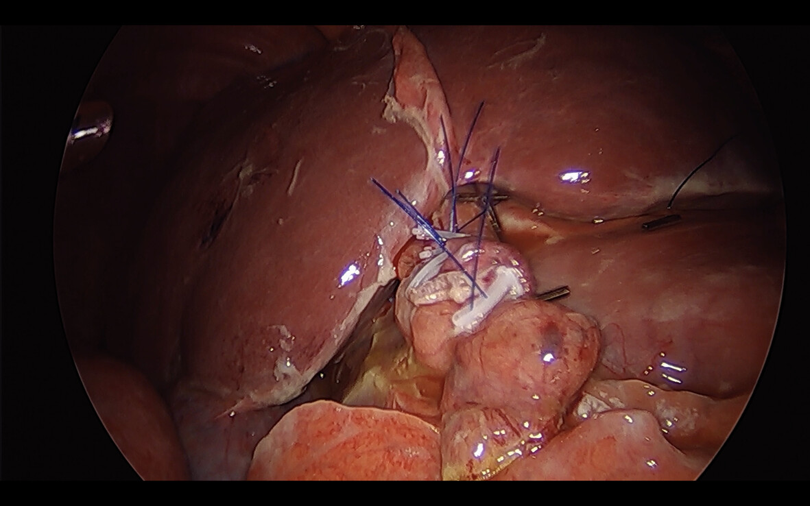 How to do laparoscopic repair of perforated anterior duodenal ulcers: a ‘three arches’ falciform patch technique simplifies the approach