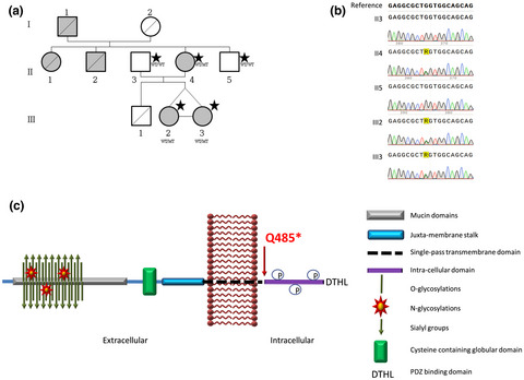 Atypical focal segmental glomerulosclerosis associated with a new PODXL nonsense variant