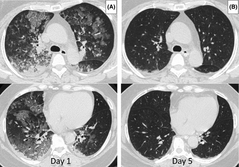 Seizure followed by lung edema: An intriguing link between the brain and the lung