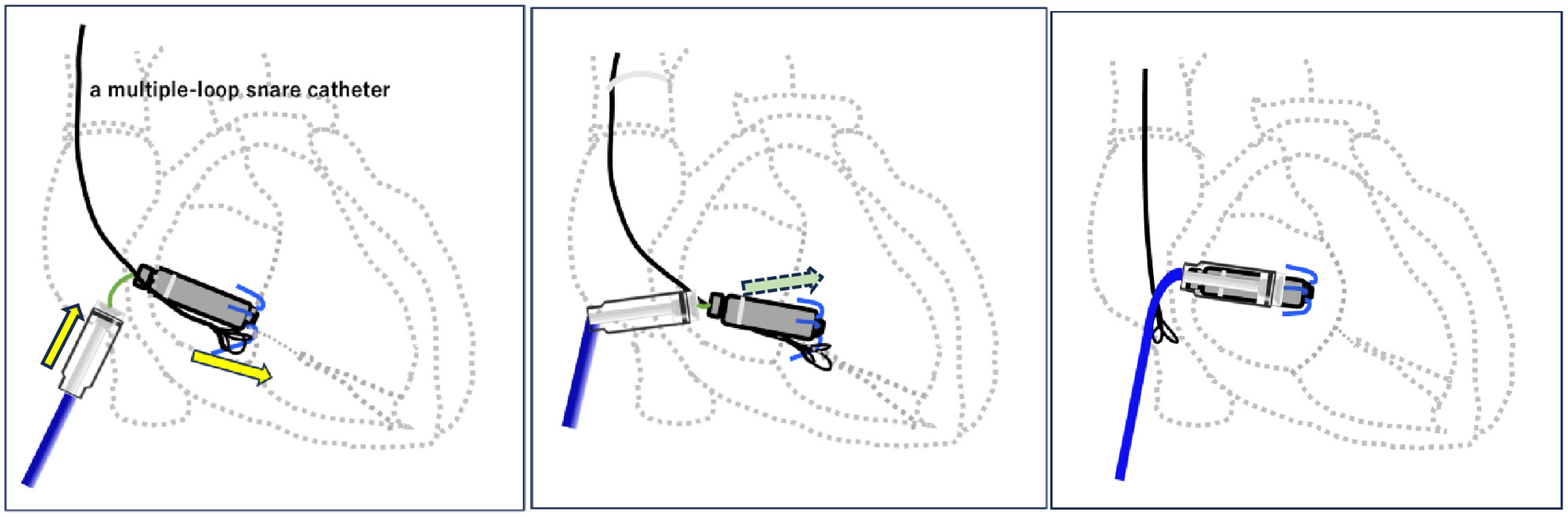 Single snare pushing technique: A new bailout technique for retrieving Micra fixed in the tricuspid valve annulus