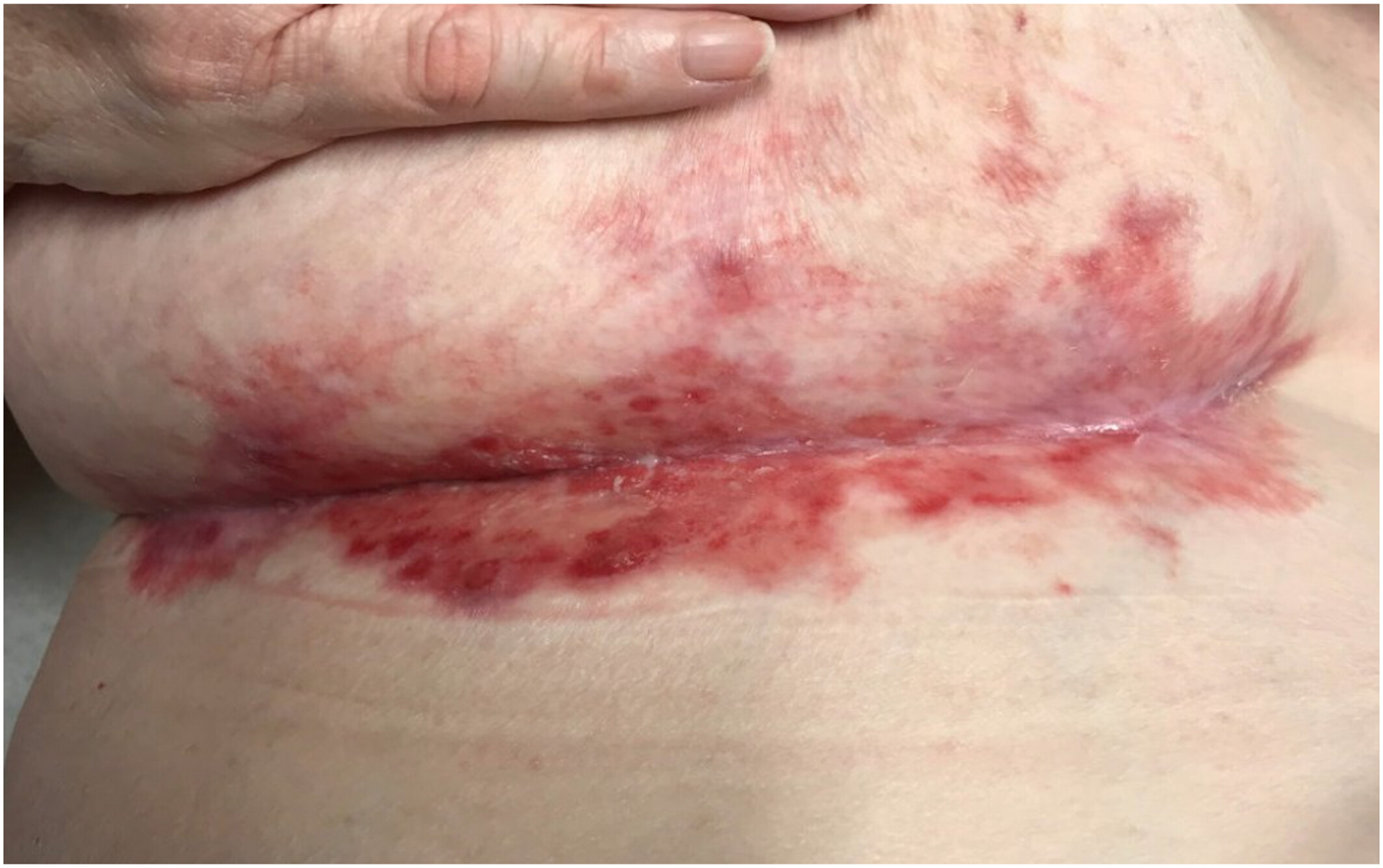 Malignant transformation of post-radiation induced erosive lichen planus to squamous cell carcinoma