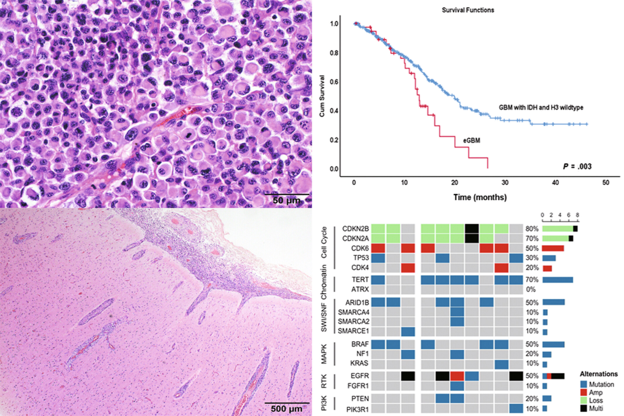 Adult epithelioid glioblastoma exhibits an extremely poor prognosis and high frequency of SWI/SNF complex mutation: Insights from a retrospective study