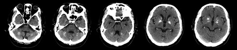 Computed tomography anomalies associated with isolated hypoparathyroidism