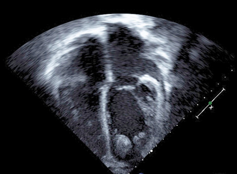 Intracardiac thrombus formation and thromboembolic events in children with cardiomyopathies: A single-center case series