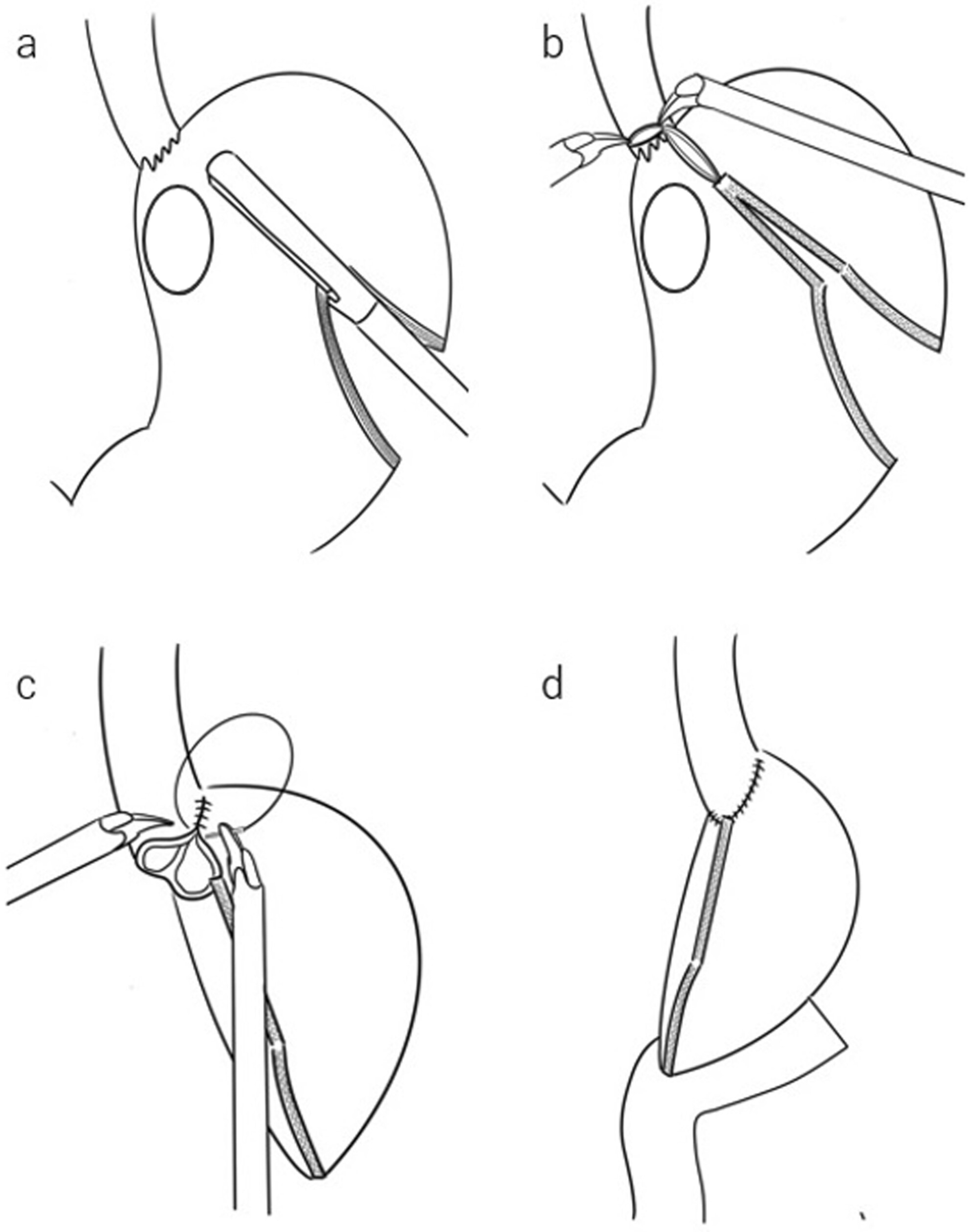 Super Subtotal Gastrectomy: A Novel Reconstruction Concept for Upper Gastric Cancer That Preserves the Fornix