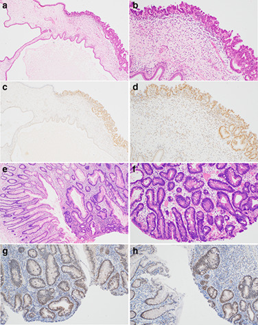 Molecular and clinicopathological analysis of three cases of gastric juvenile polyposis