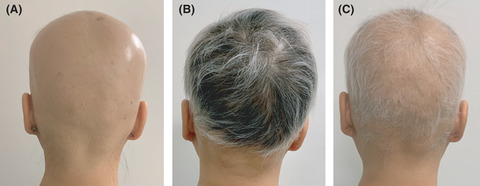 Hair regrowth and maintenance in alopecia universalis patient treated with nonablative Er:YAG laser