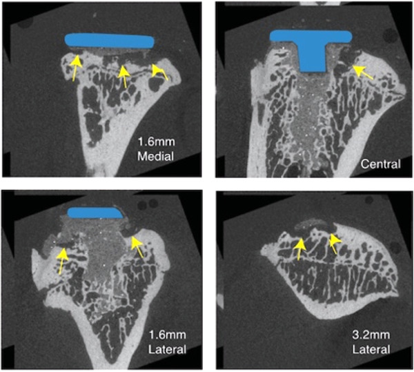 Progressive loss of implant fixation in a preclinical rat model of cemented knee arthroplasty