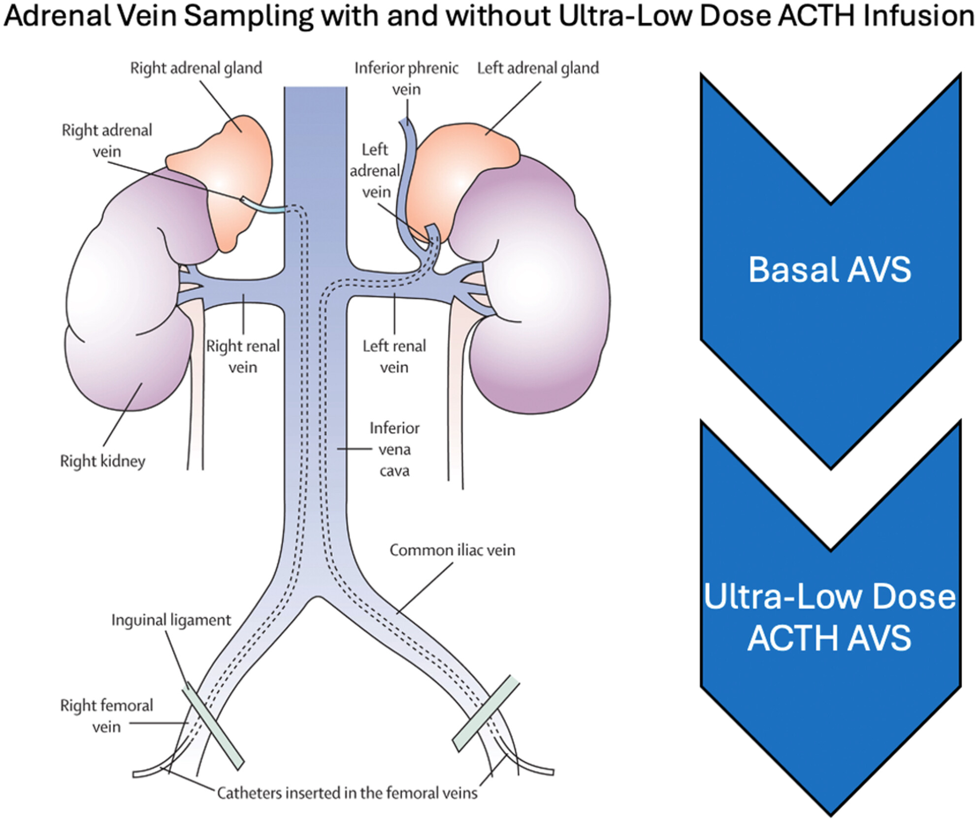 Utility of Adrenal Vein Sampling With and Without Ultra-Low Dose ACTH Infusion in the Diagnostic Evaluation of Primary Aldosteronism