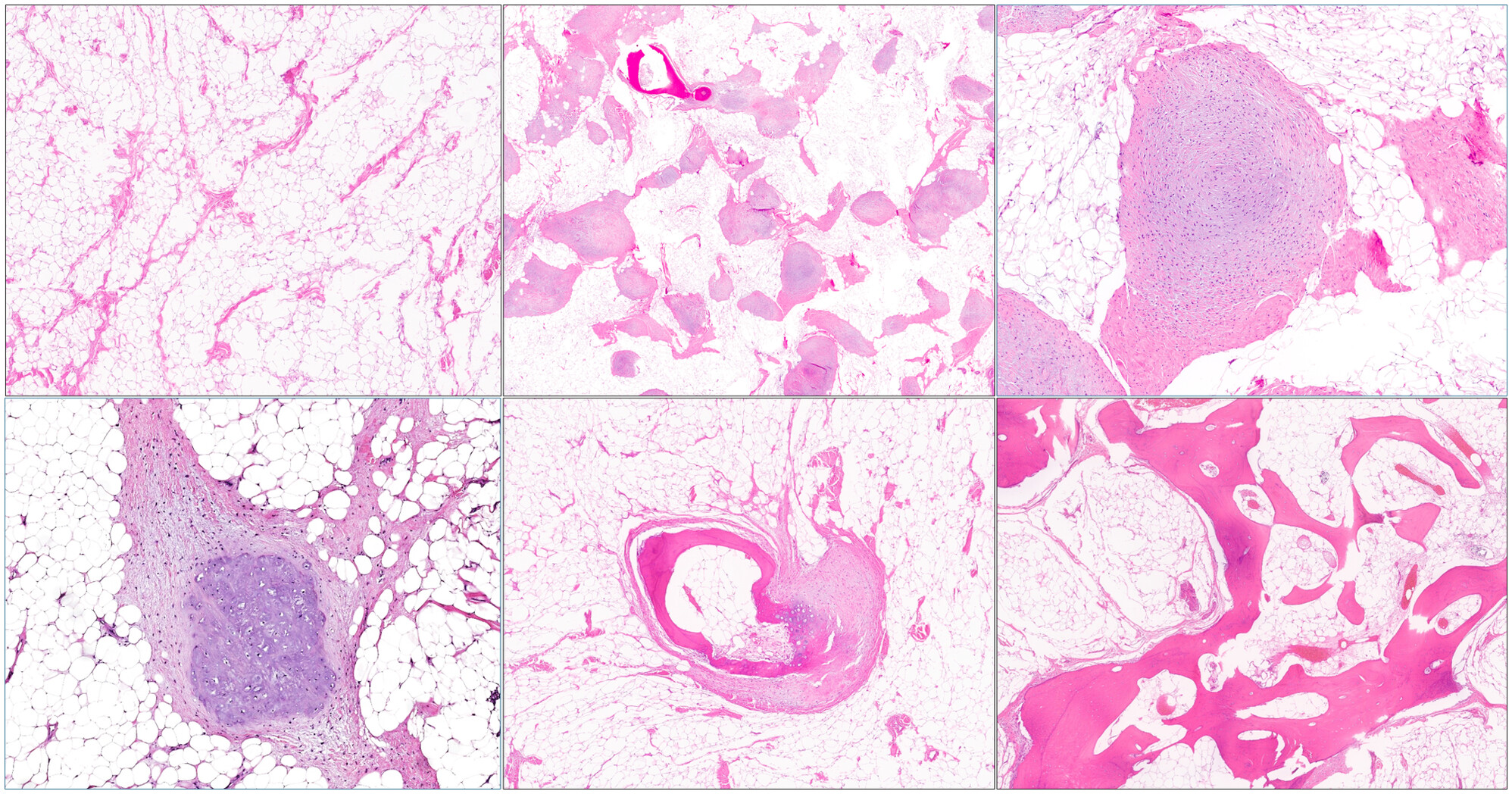 Osteolipomas revisited: a detailed clinical, histologic and molecular characterisation