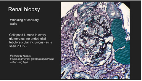 Collapsing focal segmental sclerosis in an HIV-negative patient