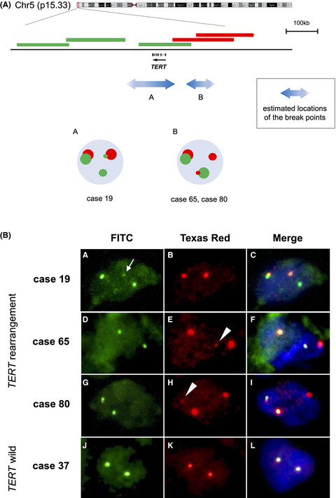 High prevalence of TERT aberrations in myxoid liposarcoma: TERT reactivation may play a crucial role in tumorigenesis