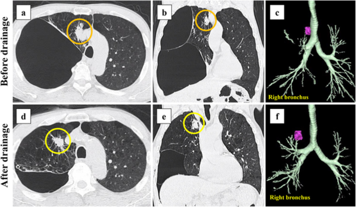 Treatment strategy for primary lung cancer in a lung highly compressed by giant emphysematous bullae: A case report