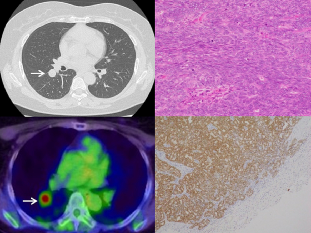 Pulmonary metastasis with coexisting pulmonary mucosa-associated lymphoid tissue (MALT) lymphoma 20 years after endometrioid adenocarcinoma surgery: A case report