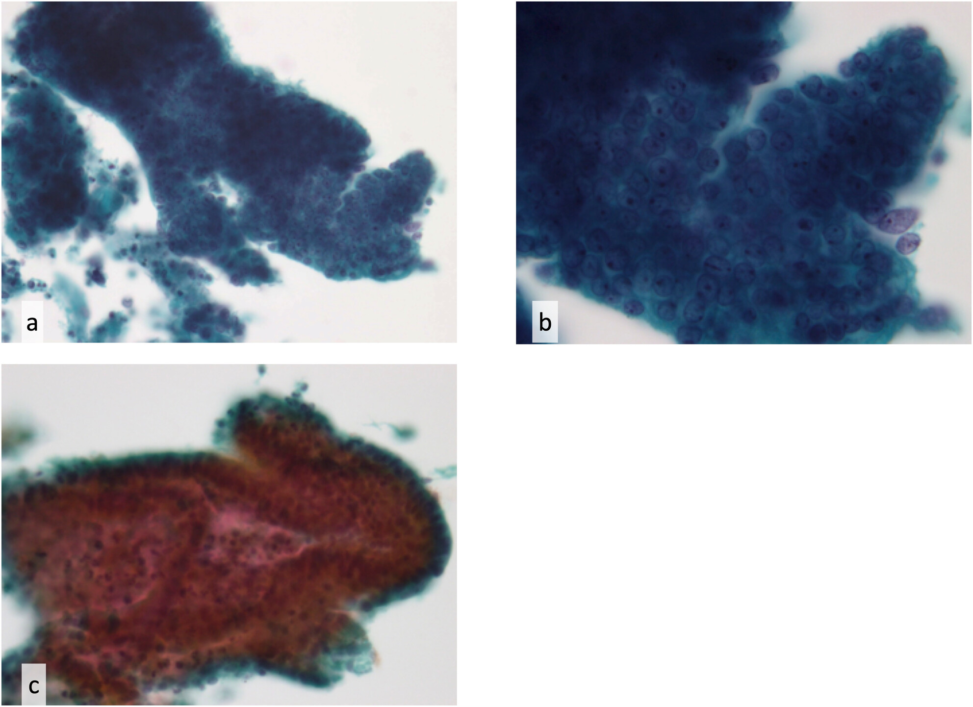 Evaluation of Diagnostic Accuracy of Directly Sampled Endometrial Cytology Using ThinPrep for Endometrial Malignancies: Comparison With Existing Endometrial Liquid-Based Cytology