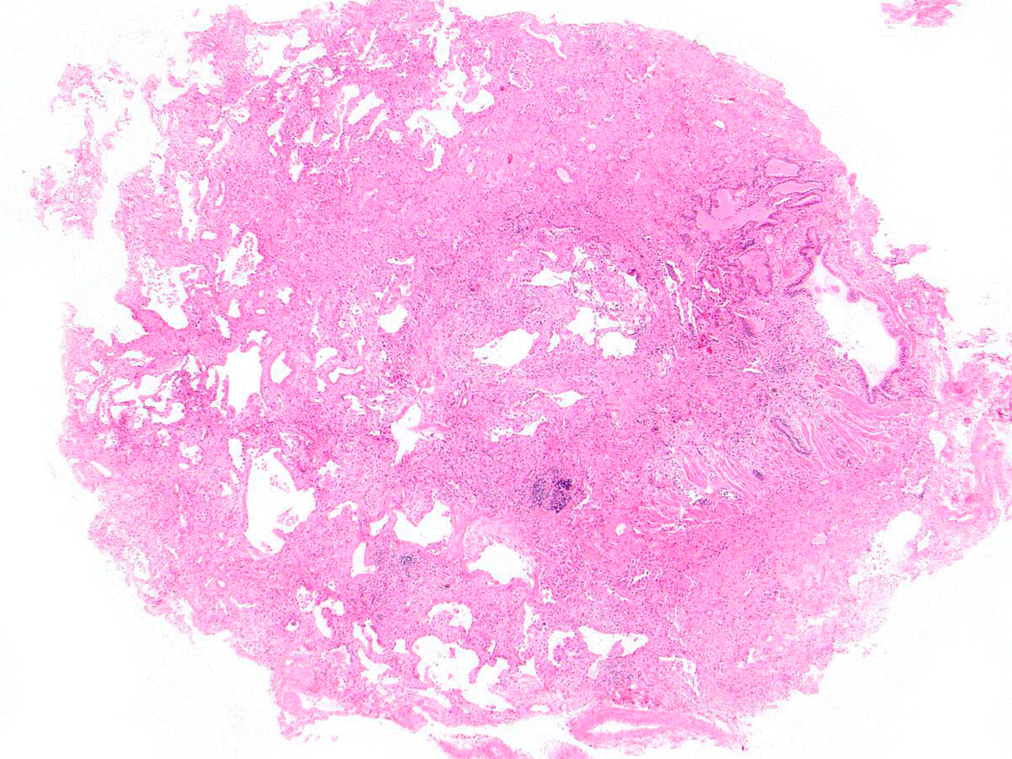 Pathological features of connective tissue disease-associated interstitial lung disease in transbronchial cryobiopsies