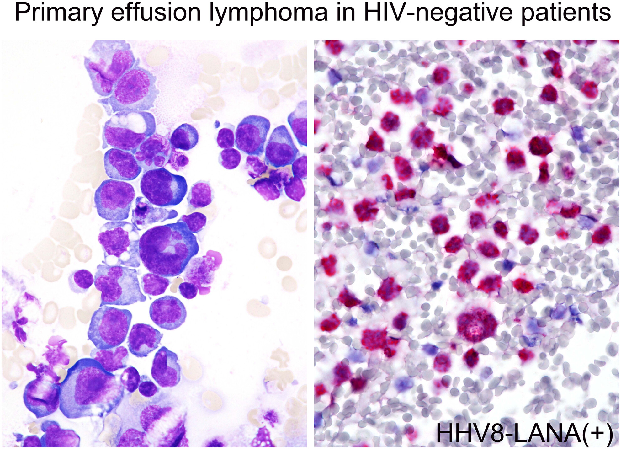 HIV-negative primary effusion lymphoma: a series of seven cases