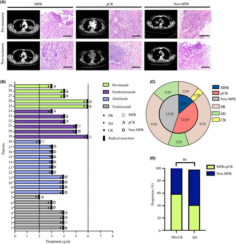 Tumor immune microenvironment predicts the pathologic response of neoadjuvant chemoimmunotherapy in non–small-cell lung cancer