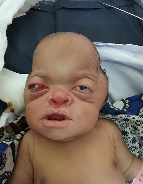 Pfeiffer Syndrome type 2; A case report of cranio-orbitofaciostenosis with bilateral choanal atresia at Muhimbili National Hospital, Tanzania