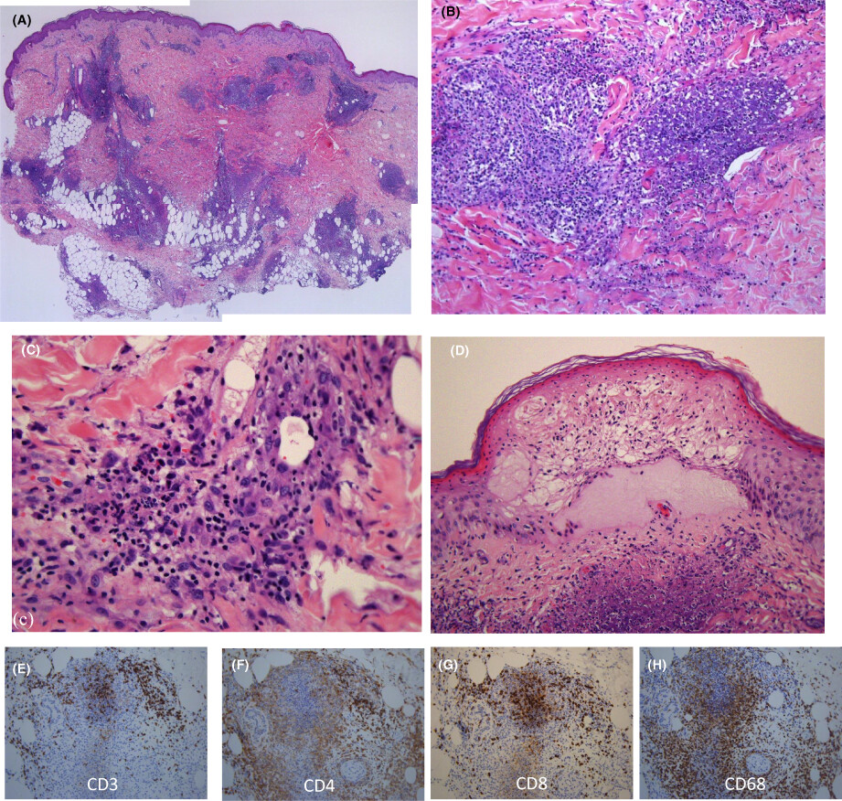 Neutrophilic dermatosis with necrobiotic changes as an unusual manifestation after the first shot of a COVID-19 mRNA vaccine together with a high fever and liver injury
